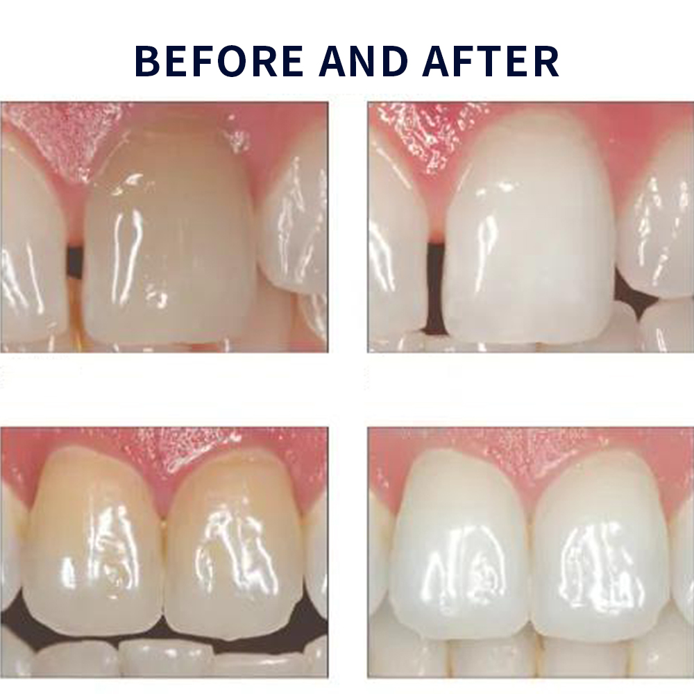 Opalescence Whitening 20% PF 2 - Teeth Whitening Doctor ulasan dan harga