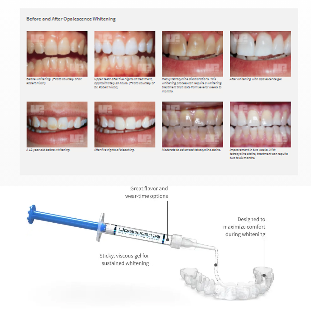 Opalescence Whitening 20% PF 2 - Teeth Whitening Doctor ulasan dan harga